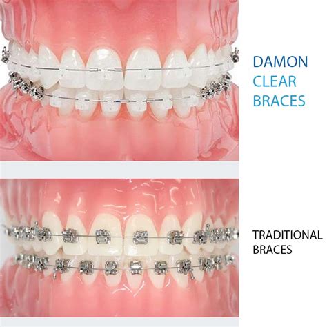 damon brackets vs metal braces|cost of damon clear braces.